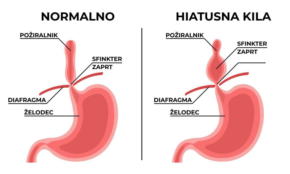 Mastika hiatusna kila zelodec slika 1
